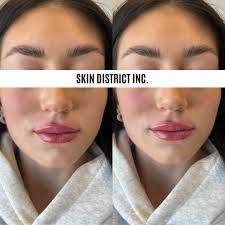 Lip Filler by Nurse Melissa Caprio. She's booking into April for lip  fillers. DM us or text 604-818-1580 to get in 💌 Only for the month of  April! Half Syringe