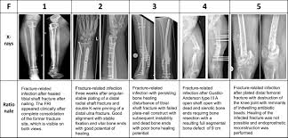 Image result for Fracture Types
