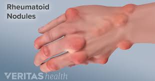 Pin On Acid Reflux Cancer
