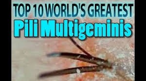 Pili multigemini is a rare developmental defect of hair follicles. World S Greatest Top 10 Pili Multigemini 1 10 Complete Youtube