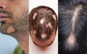 leidest du unter kreisrundem haarausfall dr levent acar