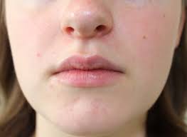 Viele menschen erleben dieses problem im seborrhoisches ekzem im gesicht ist auch auf ein starkes wachstum von hefepilzen. Periorale Dermatitis Wikipedia