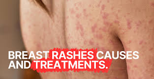 Image result for Candidiasis under breasts