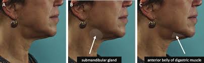 Deep Neck Lift: Defining Anatomical Problems and Choosing Appropriate  Treatment Strategies