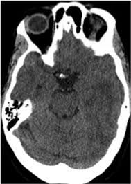 Cerebral Amyloid Angiopathy Related Inflammation With Images Inflammation Radiology Neurology