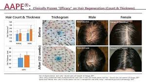 Amazing stem cell hair restoration before & after photo. Aape Stem Cell Hair Loss Therapy Trichology Centre Toronto