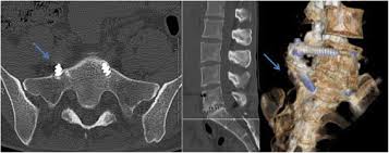 Length Of Stay Costs And Complications In Lumbar Disc Herniation Surgery By Standard Plif Versus A New Dynamic Interspinous Stabilization Technique Springerlink