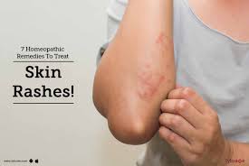 Homeopathic medicines like apis mel, sulfur, thyreoidinum, psorinum etc for treating skin allergies like hives, urticaria, red rashes. 7 Homeopathic Remedies To Treat Skin Rashes By Dr Jagmati Singh Lybrate