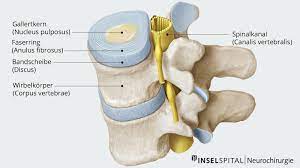 Jede bandscheibe lässt sich in zwei bestandteile einteilen. Bandscheibenvorfall Neurochirurgie Inselspital Bern