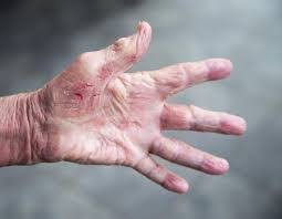 Sporotrichosis is a disease caused by the infection of the fungus sporothrix schenckii. What Is The Best Way To Go About Removing A Rose Thorn From My Finger Quora