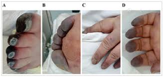 Can the covid vaccine (which is actually an experimental genetic treatment) shed something harmful that can be passed from person to person? Manifestacoes Cutaneas Associadas A Covid 19 Uma Analise Critica Dos Dados Pebmed