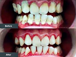 Servis perkhidmatan yang cepat dan juga sangat murah untuk rawatan gigi yang sihat bersih. Rawatan Scaling Gigi Klinik Pergigian Erfa Kl Terbaik Bagus Servis