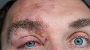 Image result for Varicella zoster on human skin