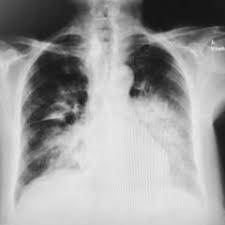 La maladie du légionnaire ou légionellose est une atteinte des poumons par un microbe, la legionella pneumophila. Atypische Pneumonie Doccheck Flexikon
