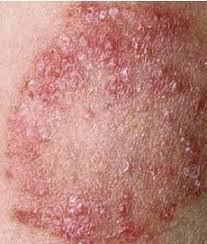 Ini termasuk dermopati diabetes, necrobiosis lipoidica diabeticorum, melecur, dan eruptive xanthomatosis. Kulat Punca Kurap Pressreader