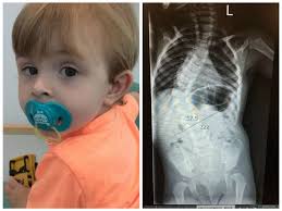 This young boy's spine is becoming so crooked it could damage his vital  organs