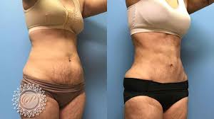 By utilizing the before and after photos of tummy tucks, you can see how your problem areas can be resolved through this surgical procedure. 42 F After Mini Tummy Tuck Lipo 360 Petrungaro Plastic Surgery