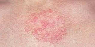 Was sind die symptome von pfeiffersches drüsenfieber? Symptom Hautausschlag Was Steckt Dahinter
