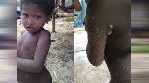 90 keluarga orang asli suku kaum bateq di kampung pasir linggi dekat gua musang, kelantan membina rumah bangsal di atas bukit sebagai tempat panik serta takut dengan penyakit merebak, menyebabkan orang asli di kuala koh bertindak mengebumikan mayat anggota suku kaum itu. Penyakit Misteri Serang Orang Asli 120 Orang Suku Kaum Batek Semakin Buntu Maskulin