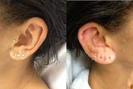 Complications Of Ear Piercing Perichondritis And Ear Disfigurement