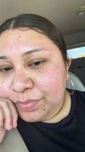 How to reduce large pores and sebaceous filaments?