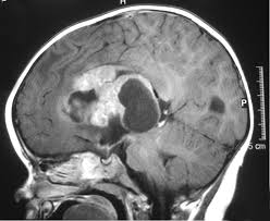 However, there are certain types of rare tumors that only appear in children. Atypical Teratoid Rhabdoid Tumor Wikipedia