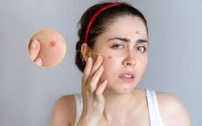 Image result for Pustule