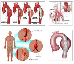 & disección de la aorta. Aneurismas Aorta Toracica Aneurismas Com Mx