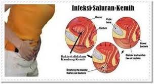 Sistem saluran perkemihan, atau saluran urinaria, bertanggung jawab untuk membuang ginjal itu seukuran kepalan tangan. Benarkah Hubungan Seks Dapat Memicu Terjadinya Infeksi Saluran Kemih Halaman All Kompasiana Com