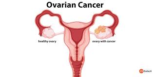 When they are caused by ovarian cancer, they tend to be persistent and a change from normal − for example, they occur more often or are more severe. Ovarian Cancer Symptoms Causes And Treatments Gomedii Healthcare Blog