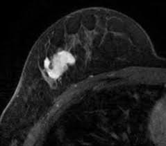 Maintaining a high volume of examinations in dedicated centers definitely impacts positively on experience in interpretation. Breast Mri Radiology Reference Article Radiopaedia Org