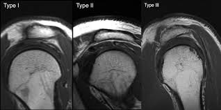 The shape of the acromion had been initially divided into three types (which was known as the bigliani classification) 3, to which a fourth acromion morphology (types) are based on sagittal oblique mri Pain Related To Rotator Cuff Abnormalities Mri Findings Without Clinical Significance Bencardino 2010 Journal Of Magnetic Resonance Imaging Wiley Online Library