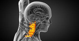 Cervical spondylosis is a common degenerative condition of the cervical spine. Pin On Spinal Stenosis