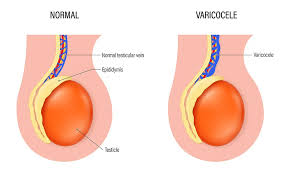 Image result for Varicocele