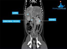 Blood is unable to be properly filtered by the puppy liver. Ct Portosystemic Shunt Fitzpatrick Referrals