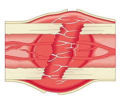 Find the perfect bone cross section stock photos and editorial news pictures from getty images. Cross Section Biomedical Illustration Of Bone Repairing Itself With Clot Forming To Seal Broken Blood Vessels And Fibrous Tissue Forming To Replace The Clot By Dorling Kindersley