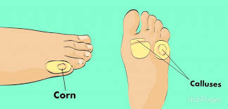 How To Get Rid Of Corns On Your Feet Naturally Get Rid Of Corns Foot Remedies Corn On Toe