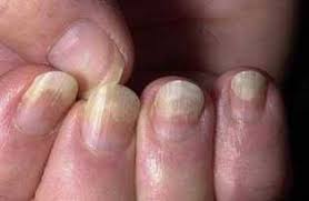 If there are streaks in your nails, your body may lack zinc, a metal usually found in the human body. 10 Diseases You Should Know That Show Up In Your Nails Health Nigeria Nail Health Nail Problems Health