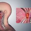 7 tips menghilangkan sakit tekak / bengkak tonsil what is the difference between other throat infections and coronavirus? 1