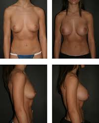 Maggie bounces her enormous tits. Breast Augmentation Wikipedia