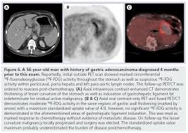 It also can let you and your doctors know if cancer treatment is working. Pet Ct Findings In Gastric Cancer Potential Advantages And Current Limitations