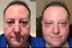 Has anyone gotten bottom surgery yet? If so are you satisfied with the  aesthetics? I'm watching 90 day fiancé the other way around with the trans  guy gabe and I'm nervous to