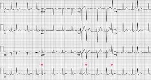 Svt and af, hearts that go fast to slow or any others probs with the beats of any kind and ablation of hearts i have had ablation done once and i am still having passing. Ektope Supraventrikulare Rhythmen Herz Kreislauf Krankheiten Msd Manual Profi Ausgabe