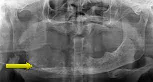 Lung cancer is formed due to pathological changes in the cell structure of the. Cureus Metastatic Tumour To The Mandible A Diagnostic And Management Dilemma
