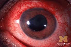 Image result for Ciliary Flush