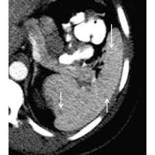 Old Granulomatous Disease Axial Ct Image Shows Multiple Small High Download Scientific Diagram