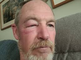 Is swelling from bee sting a concern?