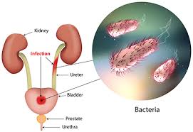Urin membawa protein bersamaan ketika mengalir keluar dari ginjal yang menjadi penyebab adanya protein dalam urin. 10 Tanda Dan Tips Mengelakkan Kencing Kotor Urinary Tract Infection Netizen Sihat