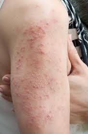 There are several types of classification criteria for psoriatic arthritis (caspar) are helpful for diagnosing psoriatic arthritis; Psoriazis Si Imunitate Cum Este AfectatÄ Pielea Csid Ce Se IntamplÄ Doctore