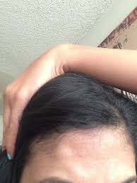 Although they aren't harmful, these bumps can be annoying. Can My Forehead Bone Bump Can Be Removed Photo